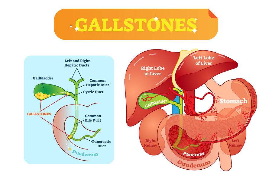 gallstones symptoms definition causes diet removal