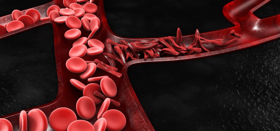 RDW Red Cell Distribution Width high low meaning