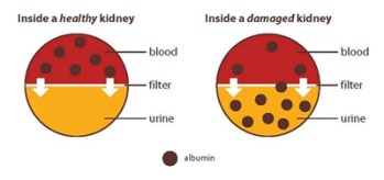 damaged_vs_healthy_kidney