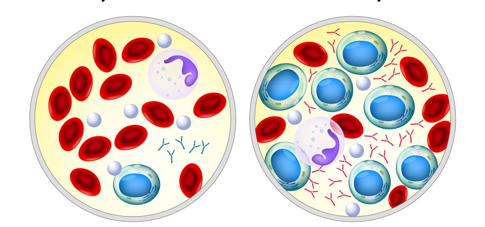 m-spike m-protein high low myeloma meaning