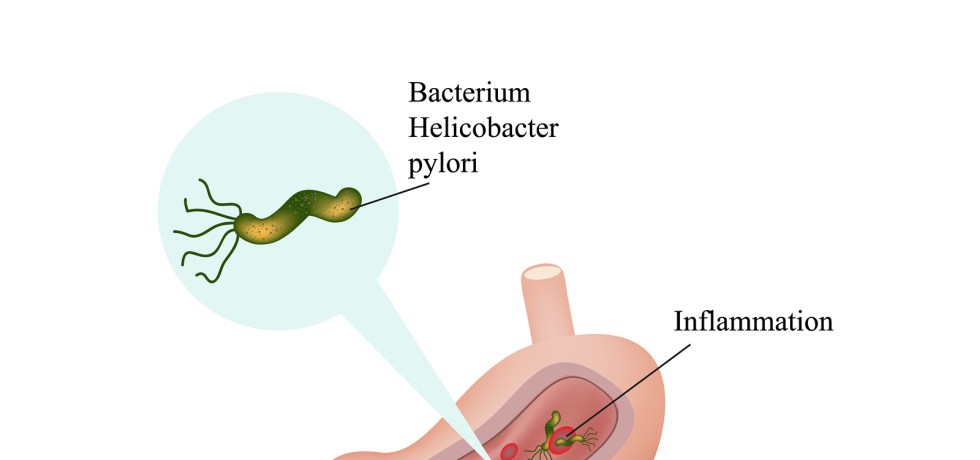 Helicobacter pylori symptoms treatment high low meaning